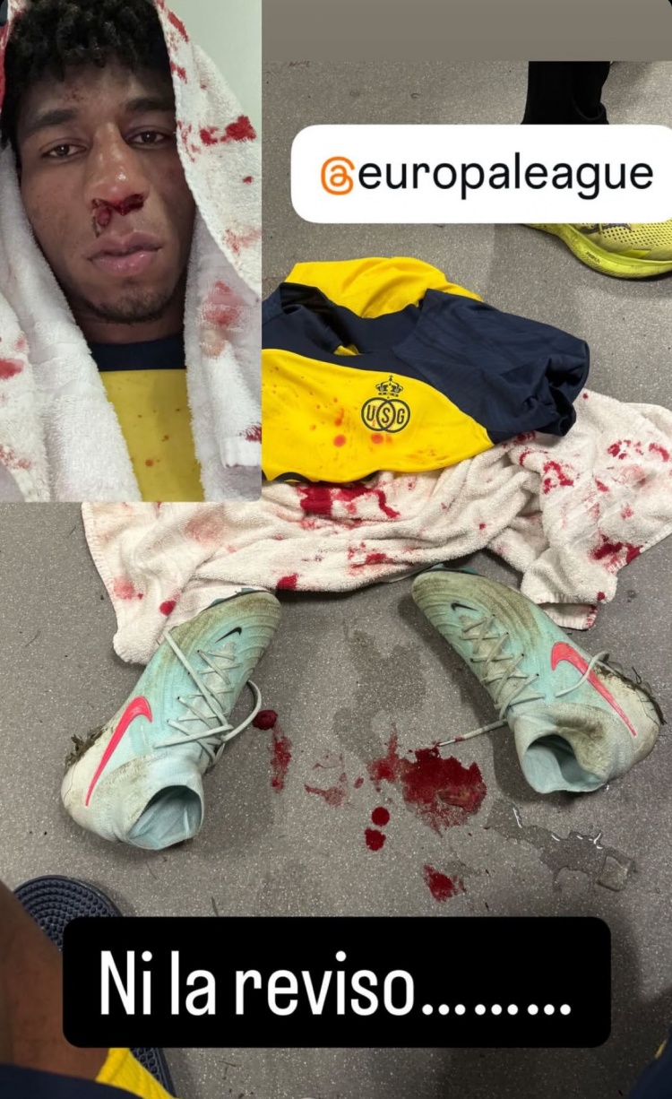  圣吉羅斯前鋒社媒曬鼻子受傷照片，質(zhì)疑裁判漏判點(diǎn)球