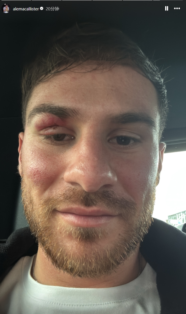  痛并快樂(lè)著！麥卡利斯特封堵馬爾穆什射門(mén)后“破相”，但心情不錯(cuò)