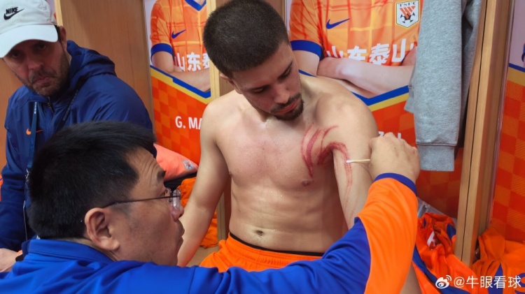  硬漢！記者曬卡扎爾受傷照，肩胛及上臂處多條血痕