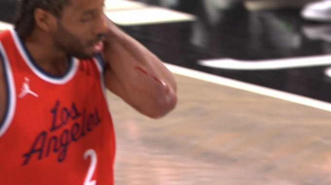  觸目驚心！小卡手臂被劃出一道長長的血痕 去場邊及時止血處理